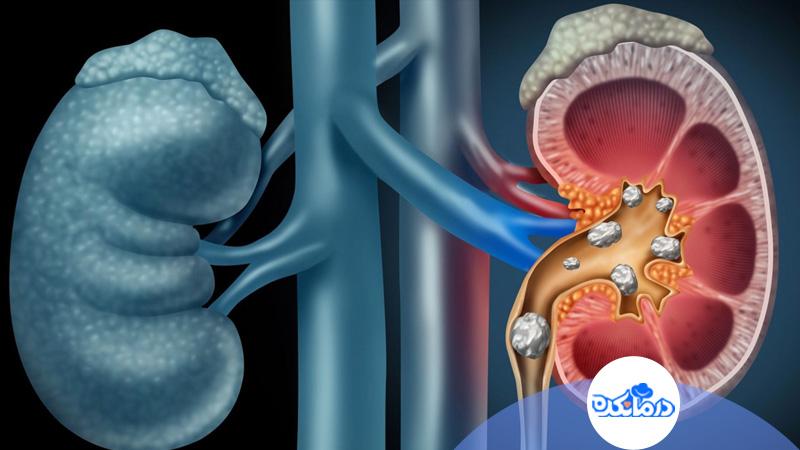 سنگ | سنگ کلیه | کودک
