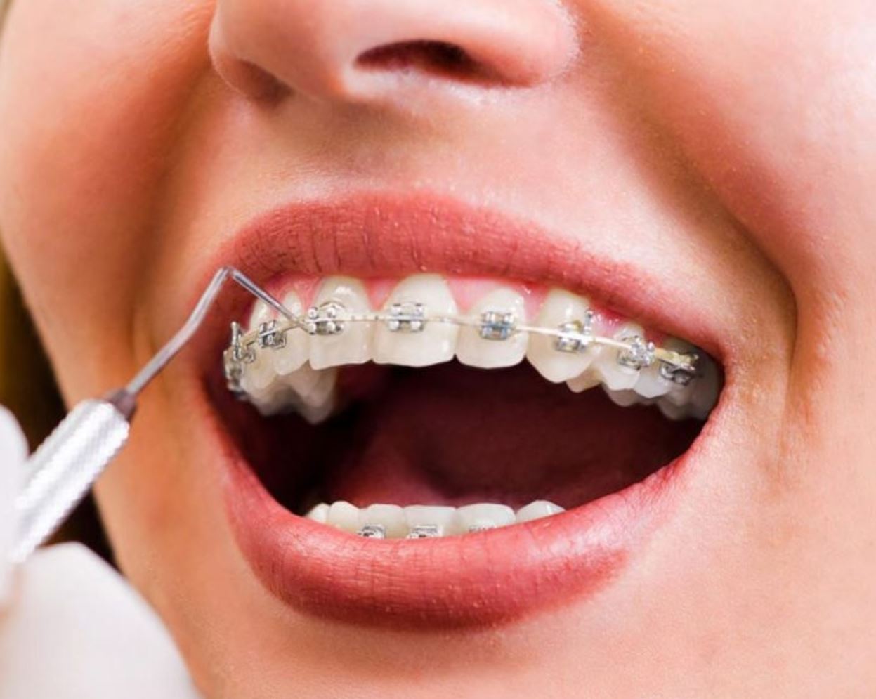 ارتودنسی | دندان