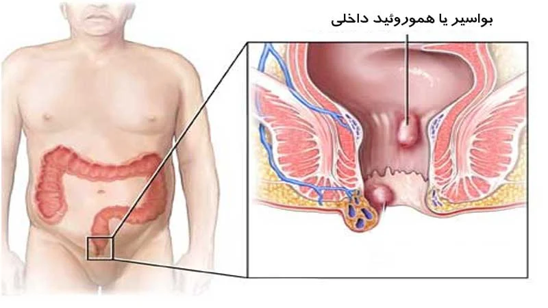 هموروئید