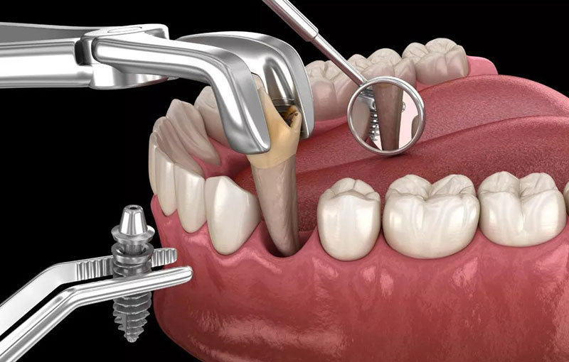 ایمپلنت | دندان | کشیدن دندان