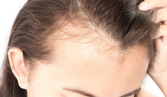 Is hormonal hair loss reversible? | Causes and treatment methods
