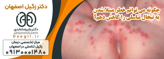 درمان زگیل در اصفهان