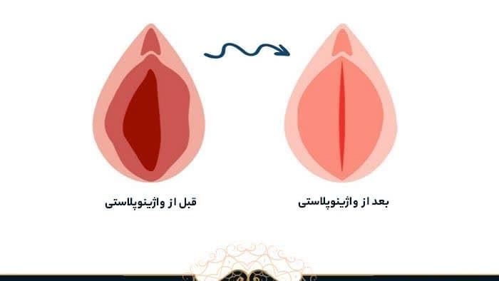 تاثیرات واژینوپلاستی بر واژن